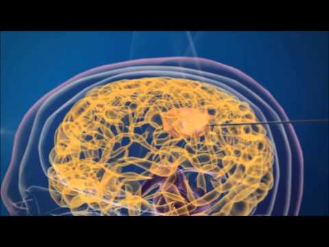 Youtube: magforce - Nutzung hochentwickelter Nanomedizin für innovative Therapien