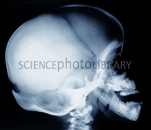 C0095371-Bone growth disorder of skull2C