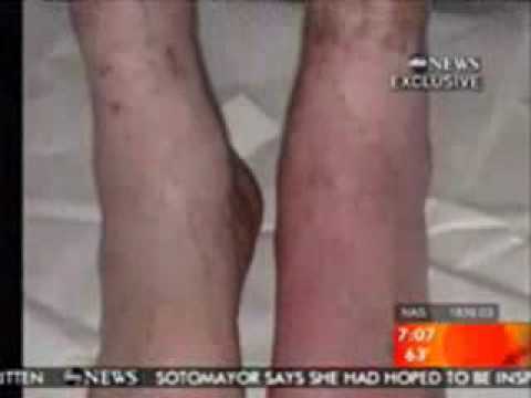 Youtube: Michael Jackson's - hole in leg injection marks Revealed