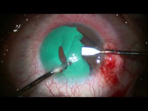 Youtube: Change Your Eye Color? Blue Eyes. Removal of Cosmetic Iris. Stephen Slade MD
