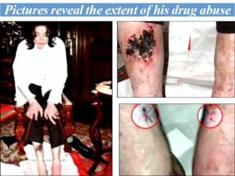 Youtube: Michael Jackson: Was The "Spider Bite" a Lie?