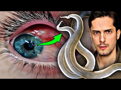 Youtube: Würmer im Auge nach Mückenstich in Deutschland