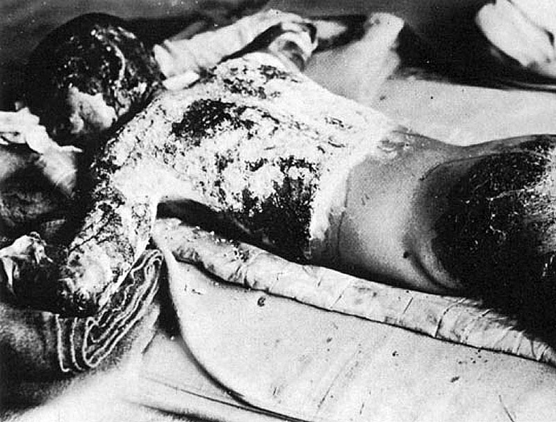 Victim of Atomic Bomb 002